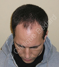 greffe cheveux homme avant - Clinique Bédard Montréal
