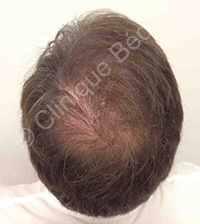 résultat microgreffe cheveux homme après - Clinique Bédard Montréal
