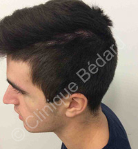 résultat greffe cheveux homme après - Clinique Bédard Montréal