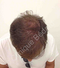 hair transplant man result after